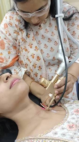 Fractional laser therapy performed by Dr. Arti Kumari